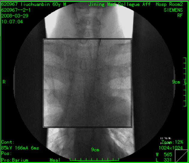 突破传统 重新定义：3D医学影像PACS系统源码（包含RIS放射信息）实现三维重8597 作者:随风西阳 帖子ID:42160 